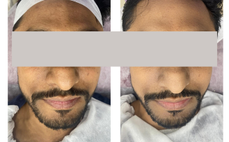 Hydrafacial Treatment (2)